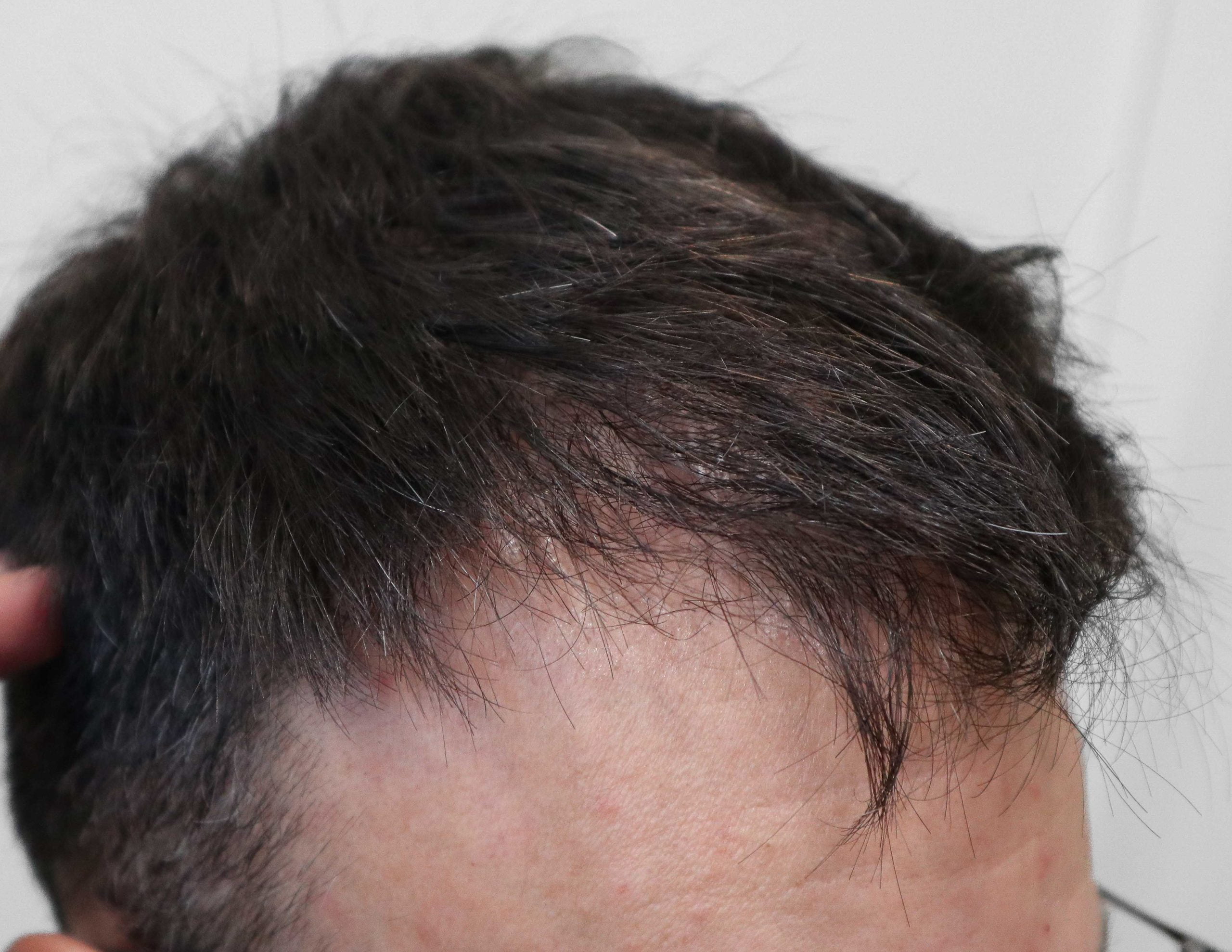 transplante_capilar_antes_4_1