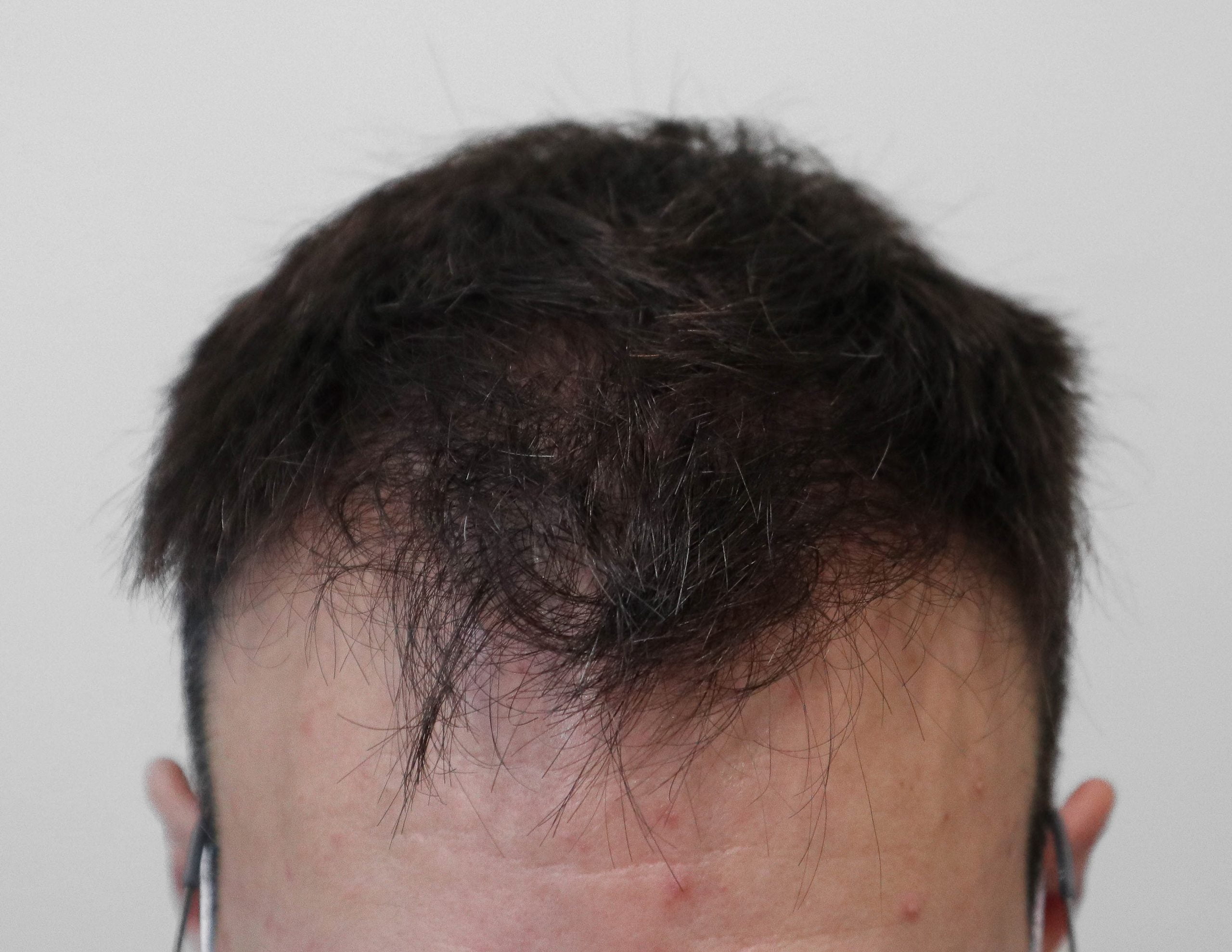 transplante_capilar_antes_4_2