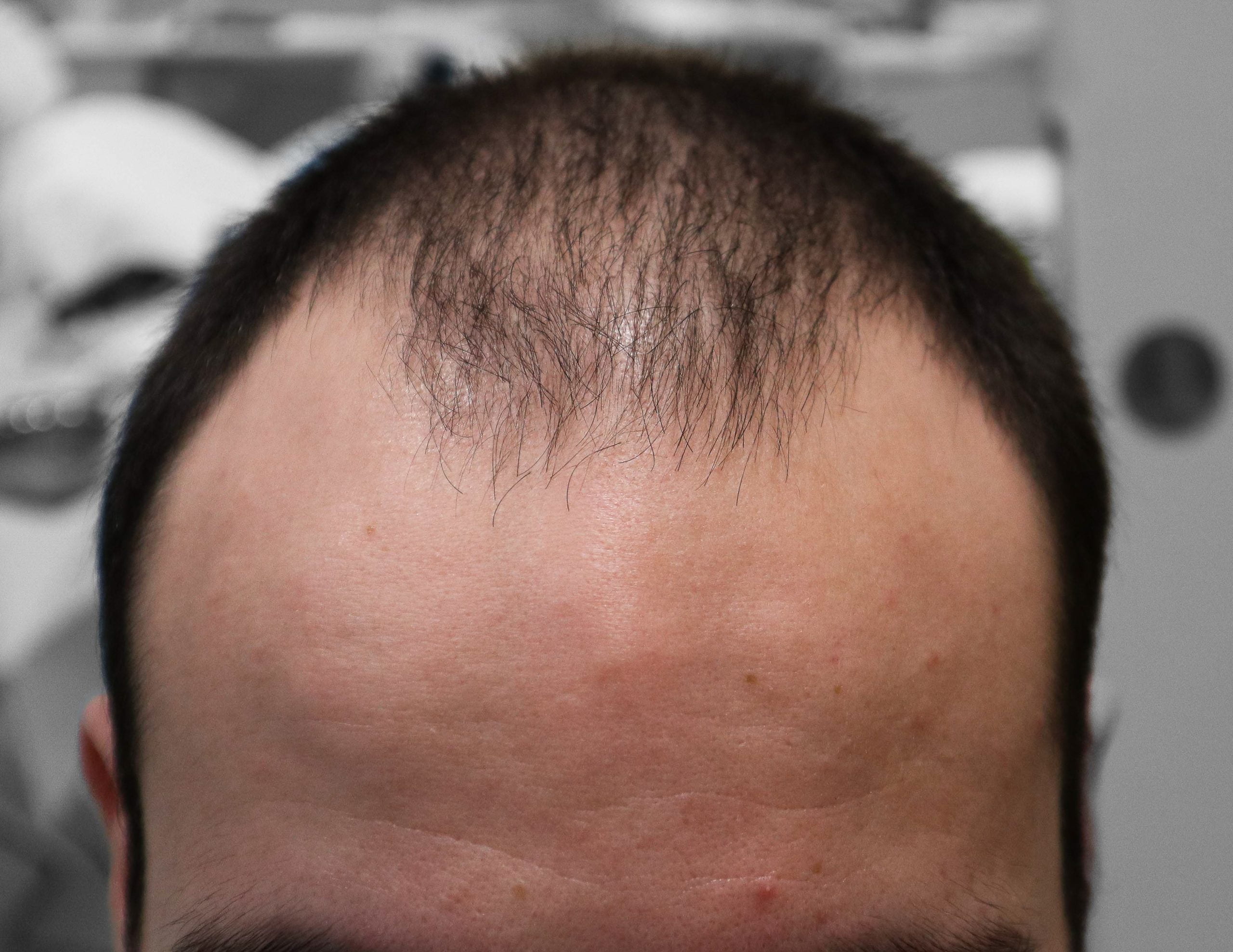 transplante_capilar_antes_5_1