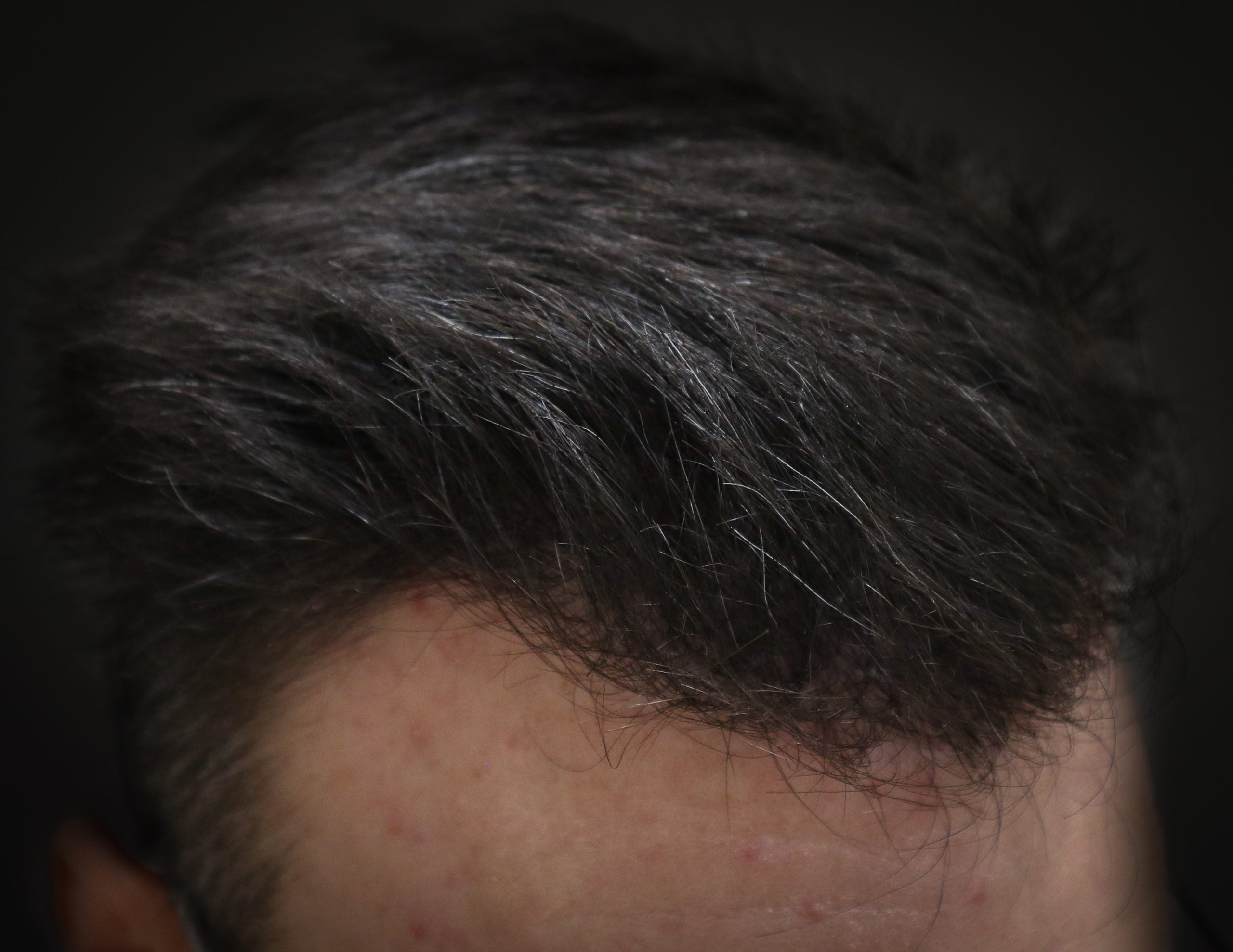 transplante_capilar_depois_4_1