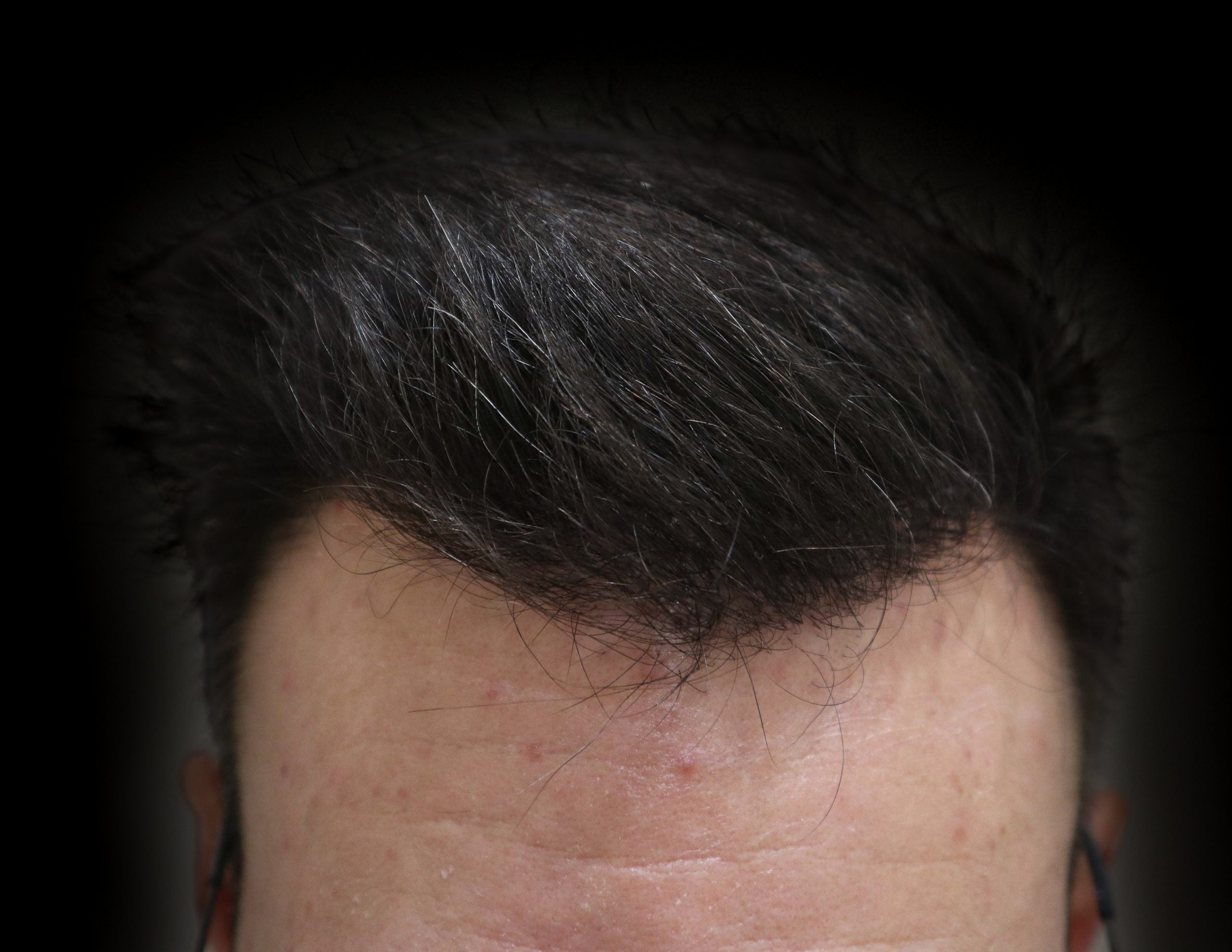 transplante_capilar_depois_4_2