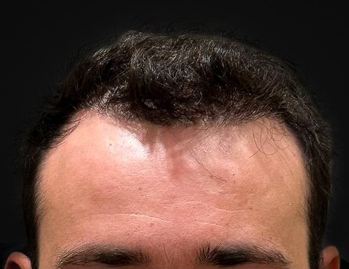 transplante_capilar_depois_5_1