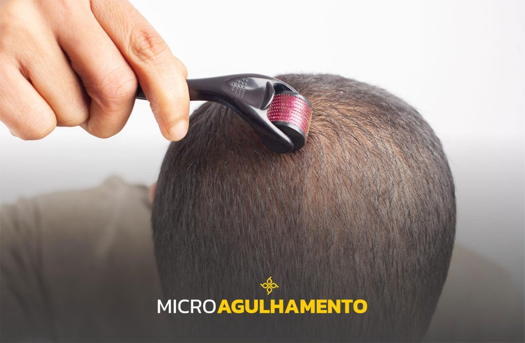 Microagulhamento capilar